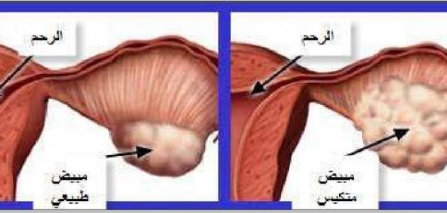 ماهي اعراض تكيس المبايض - مالا تعرفه عن تكيس المبايض 2487