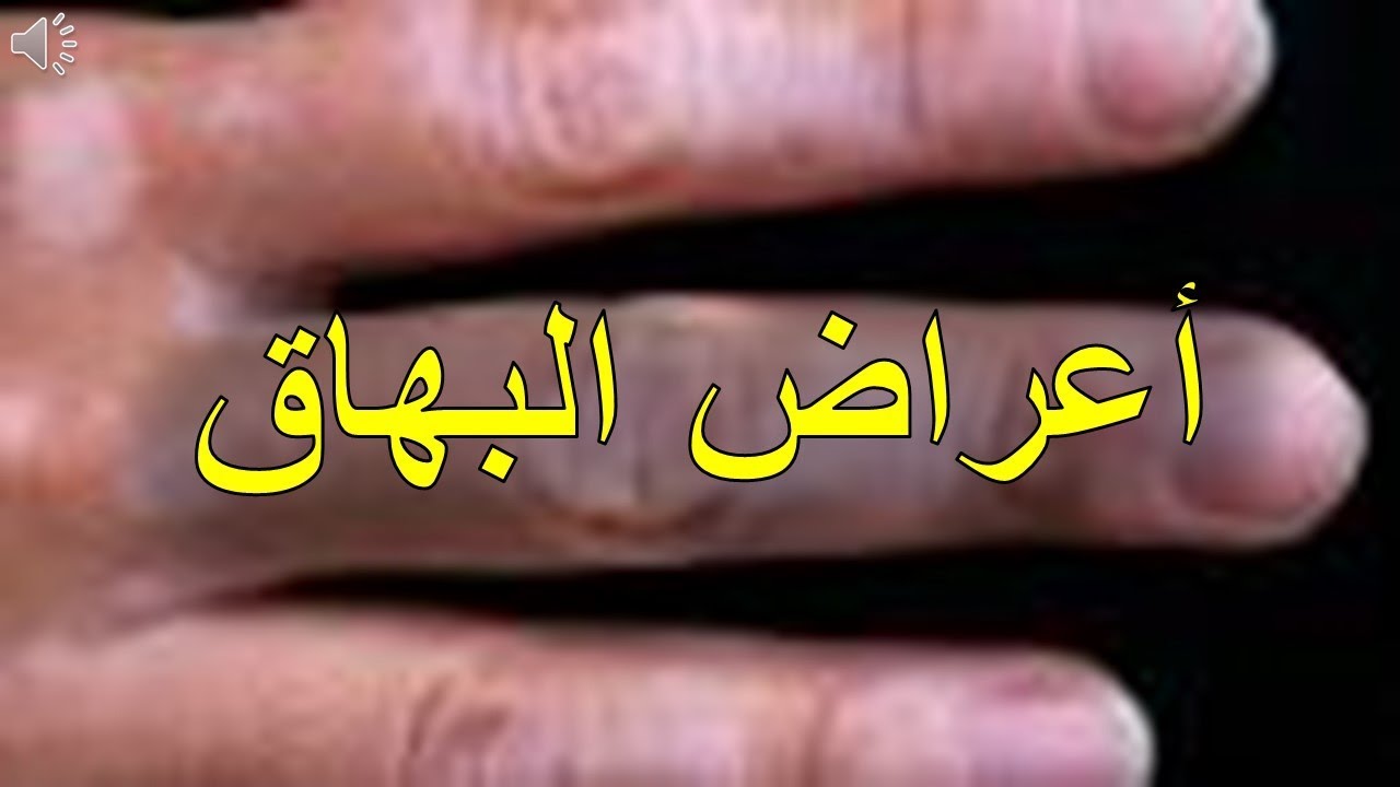 ما هي اعراض مرض البهاق-البهاق وأعراض 3245 3