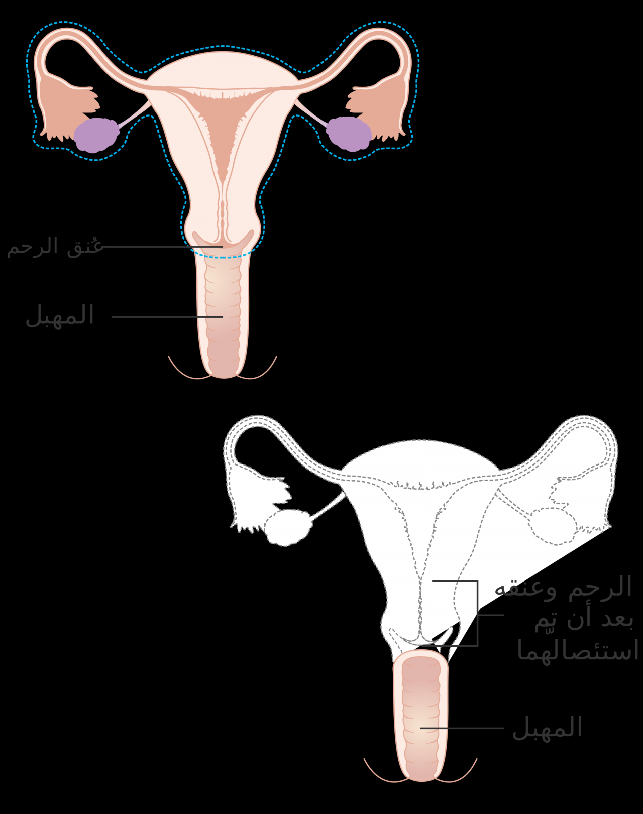 اسباب انتفاخ اسفل البطن عند الفتيات , اكثر الاسباب شيوعا لانتفاخ اسفل بطن الفتاه