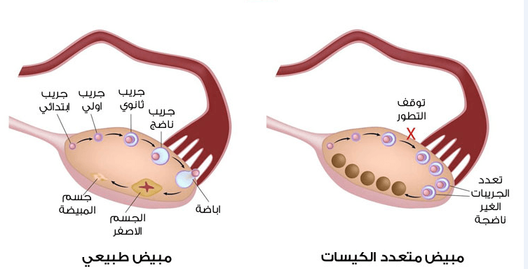 ماهي اعراض تكيس المبايض - مالا تعرفه عن تكيس المبايض 2487