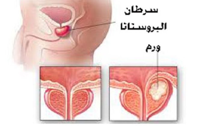 اعراض البروستاتا - اسباب امراض البروستاتا وطرق الوقاية منها 2647 1