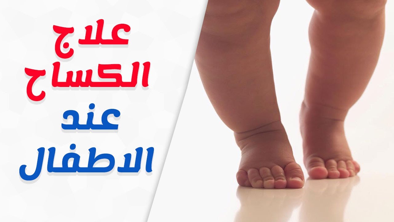 مرض الكساح , اعراض وعلاج الكساح