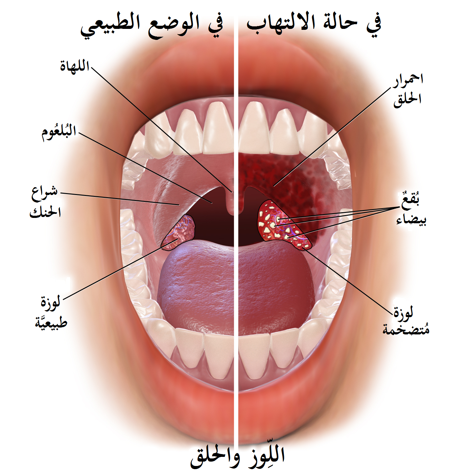 علاج التهاب الحلق - افضل العلاجات الدوائية والمنزلية لالتهاب الحلق 6302