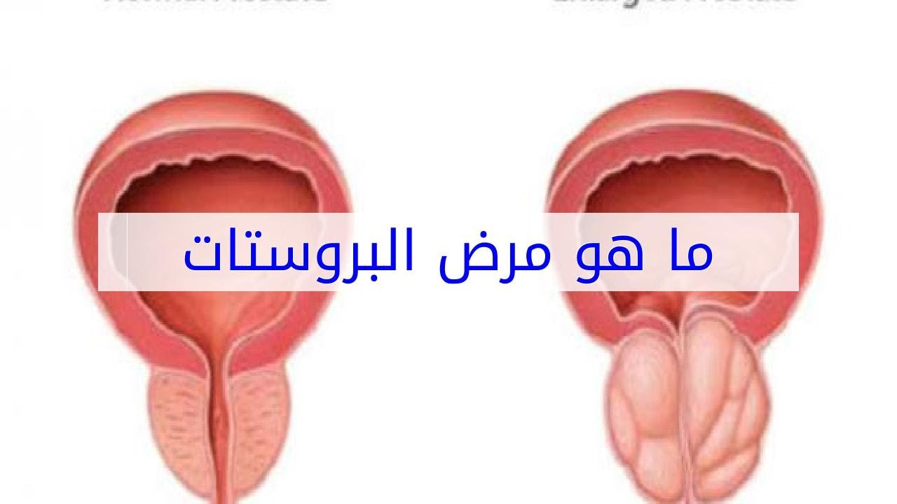 علاج مرض البروستات , انواع التهابات البروستاتا وطرق علاجها