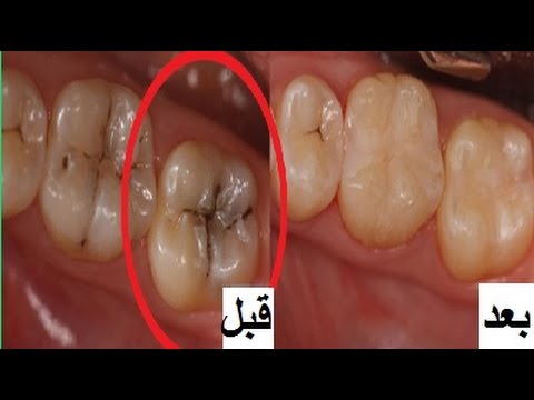 علاج تسوس الاسنان , كيفية التخلص من تسوس الاسنان