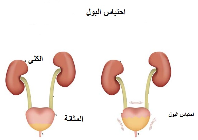 اعراض صديد الكلى - صديد الكلي والتخلص منه 11614 1