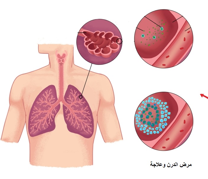 مرض الدرن , اسباب مرض الدرن وطرق الوقاية منه وعلاجه