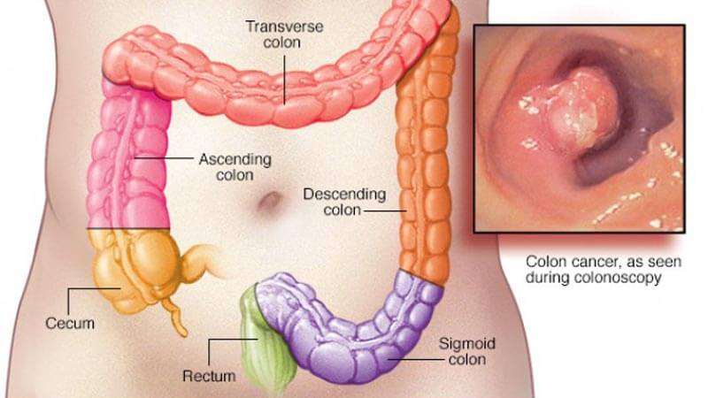 اعراض سرطان القولون - اسباب وعلاج