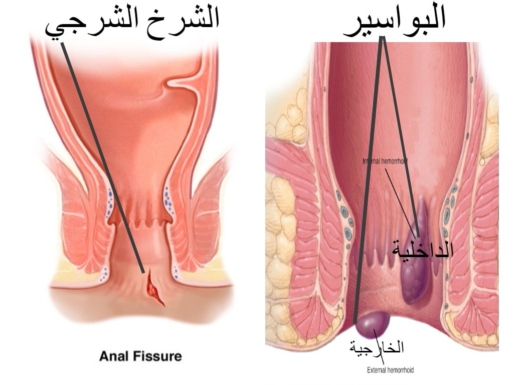 اعراض البواسير - التهاب البواسير واعراضها وطرق علاجها 2700 3