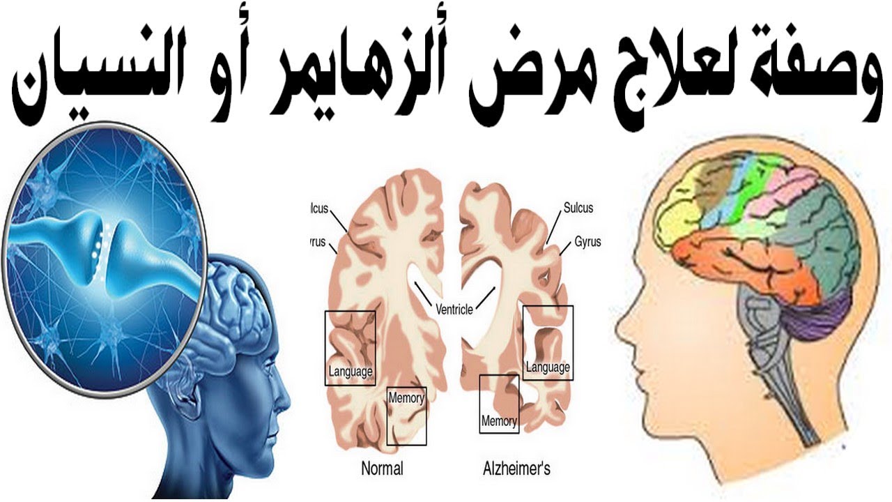 علاج النسيان - علاج النسيان نهائيا 👇 6371 1