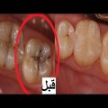 1036 3 علاج تسوس الاسنان - كيفية التخلص من تسوس الاسنان همهام رافع