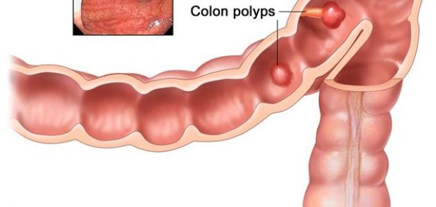 مرض القولون - اعراض القولون وعلاجه