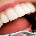 11386 13 علاج تسوس الاسنان في المنزل - اسهل علاج لتسوس الاسنان همهام رافع