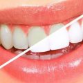 11876 3 وصفة سريعة لتبييض الاسنان - الاهتمام بالاسنان و تبيضها طروب صارم